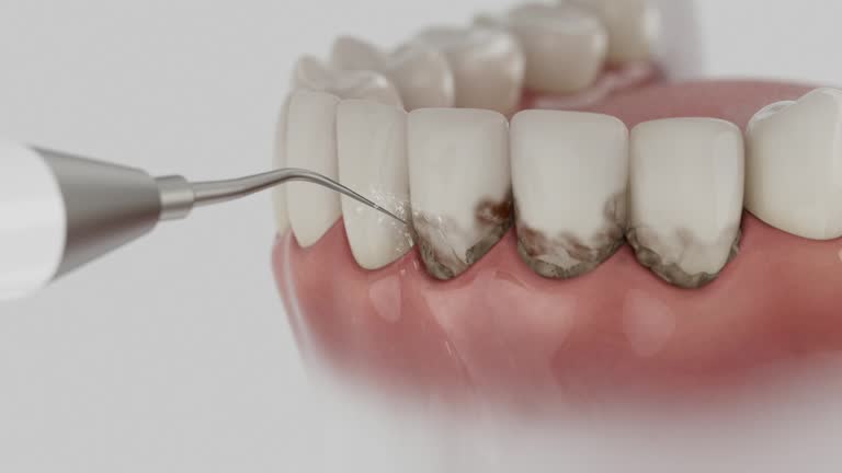 Trusted Wisdom Tooth Removal service in Milwaukee, WI - Dentist Open Now